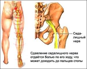проявления варикозной болезни, варикоз